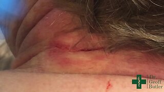 Removal of an Epidermal Cyst at the base of the neck