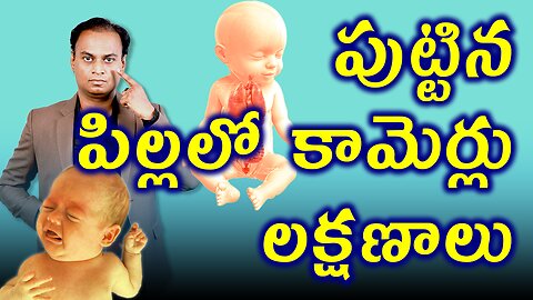 పుట్టిన పిల్లల్లో కామెర్లు లక్షణాలు సంకేతాలు | Newborn Bay Jaundice Signs Symptoms Treatment & Cure