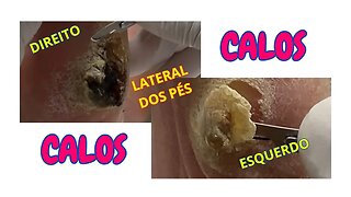 Retirando a DOR: PROCEDIMENTO completo de remoção de CALOS #unhas #pes #dor #podologia #calos