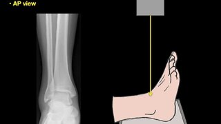 Anatomy of Ankle X-rays