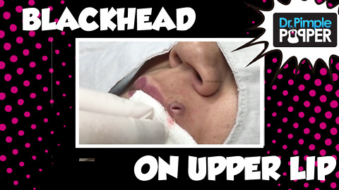 Blackhead "Button" on the Upper Lip!