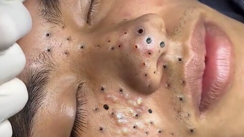 Removing Acne and Blackheads Treatment, #31