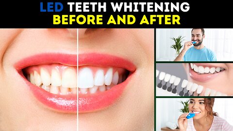 LED Teeth Whitening Before And After