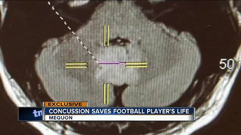 Concussion leads to life saving tumor detection for Concordia football player