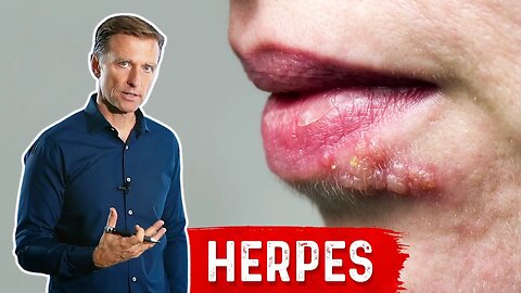 Best Foods to Eat and Avoid If You Have Herpes