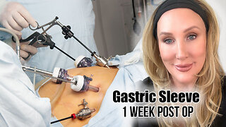 Gastric Sleeve Surgery - I week Update & Weight Loss