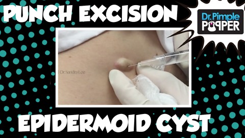 Punch excision, left flank: Epidermoid Cyst