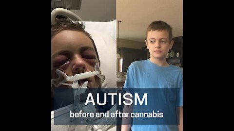 Episode 118: Cannabis Nothing Short of Miracle For Boy With Severe Autism And Seizure Disorder