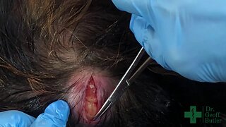 Removal of a Large Pilar Cyst