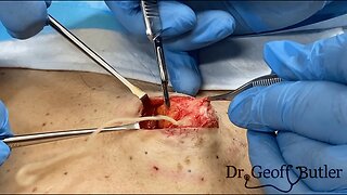 Epidermal Cyst Removal on Upper Back