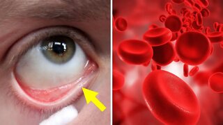 8 Signs of Anemia You Shouldn't Ignore