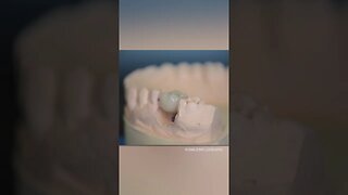 Tooth Implant Crown (DENTAL PHOTOGRAPHY)