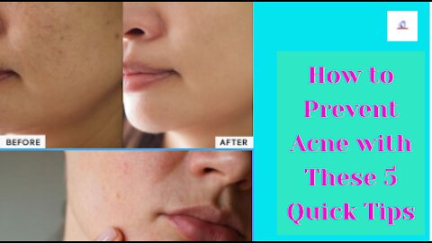 How to take care of Prevent pimples oily skin