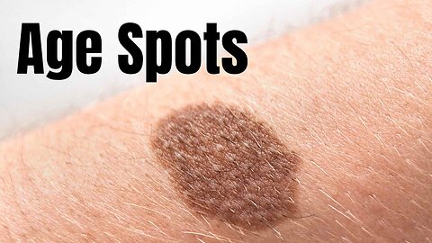What do Age Spots Mean?