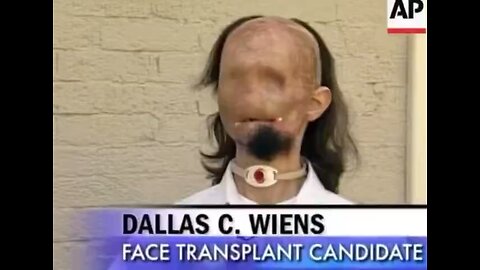 Dallas Wiens Undergoes Full Face Transplant After Severe Burns