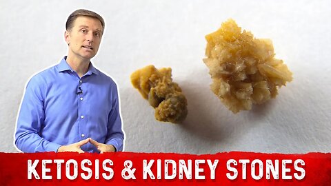Ketosis and Kidney Stone Prevention – Dr. Berg