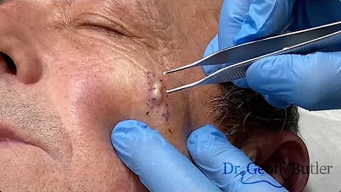 Removal of facial cyst