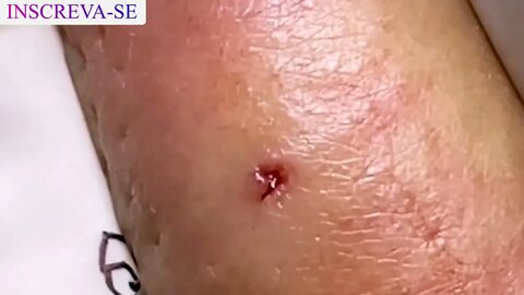 Satisfactory Video Blackhead Removal Skin Cleansing #9 | 2022 Video