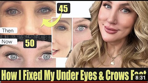How I fixed My Under Eye Wrinkles // Facial Rejuvenation
