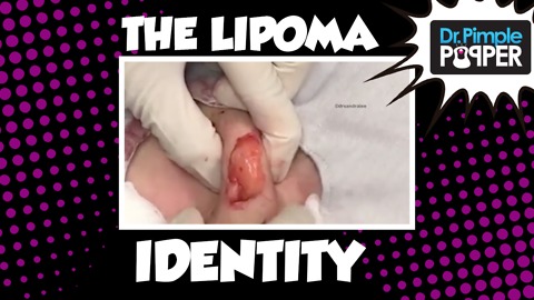 The Lipoma Identity