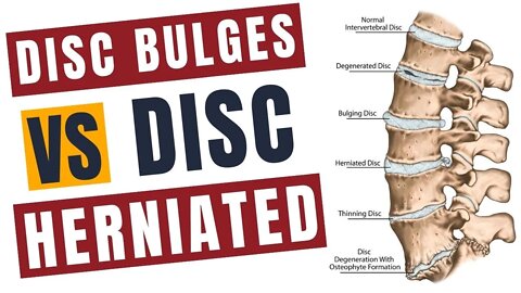 Disc Bulges vs Disc Herniated management and pain relief