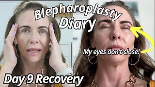 Addressing Dry Eyes after Eyelid Lift Surgery | Day 9