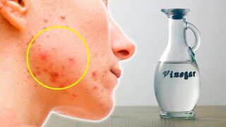 4 Cystic Acne Home Remedies that Really Work