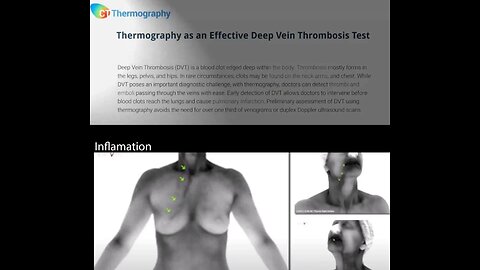 Thermal imaging devices can detect blood clots...