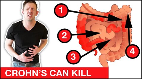 ❌ 8 DANGEROUS Crohn's Disease Signs and Symptoms That Should NEVER Be Ignored!!!