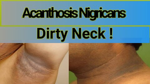 acanthosis nigricans /dirty neck/acanthosis nigricans treatment/hyperpigmentation neck treatment