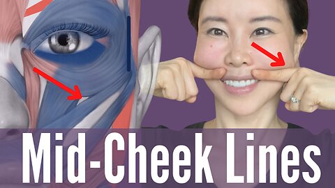 Reduce Or Eliminate Mid Cheek Lines