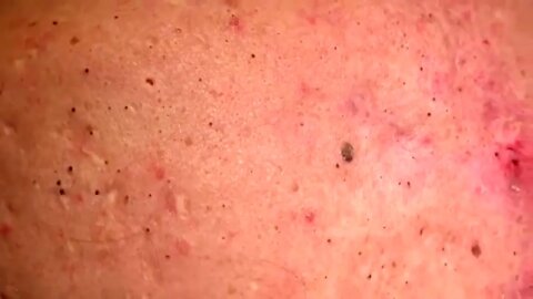 Removal / extraction of blackheads and pimples. Satisfying videos to relax!