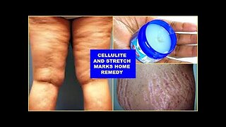 REDUCE CELLULITE AND STRETCH MARKS FAST AND EFFECTIVELY, WITH JUST 3 INGREDIENTS -Khichi Beauty