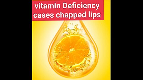 Which vitamin deficiency cases chapped lips