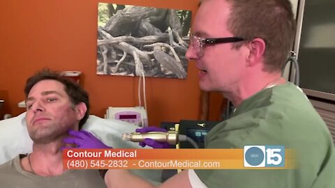 Contour Medical: New treatment to reduce scars, fine lines, acne & pores