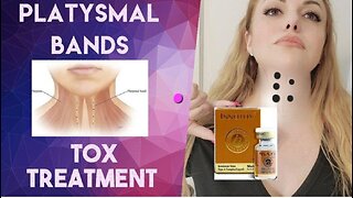 Platysmal bands Neck Treatment Part 2