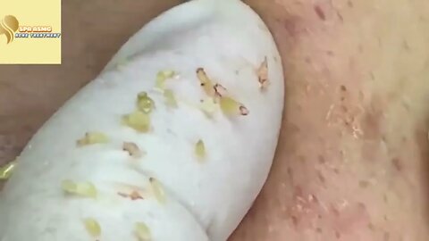Removal / extraction of blackheads and pimples. Satisfying videos to relax!