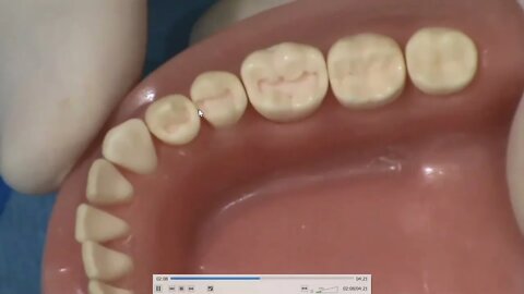 Class II (MO) Lower Second Premolar