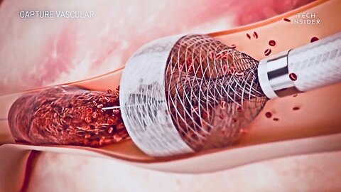New Device Removes Blood Clots Much More Efficiently - MegaVac