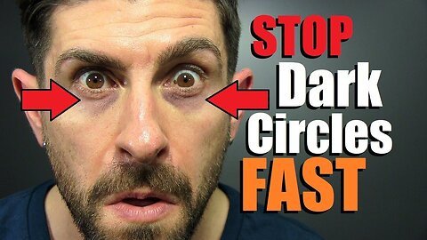 10 Tricks To FIX Dark Under Eye Circles FAST!