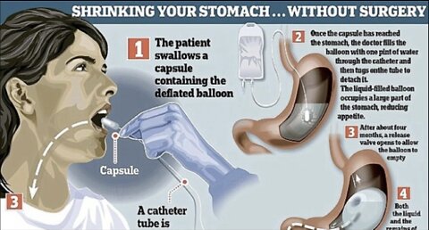 Do You Want a Balloon in your Stomach? The Pros and Cons of Gastric Balloon Surgery