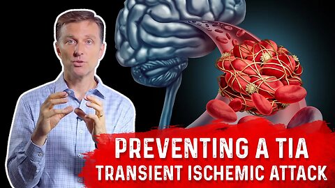 How To Prevent TIA (Transient Ischemic Attack) Mini-Stroke? – Dr.Berg