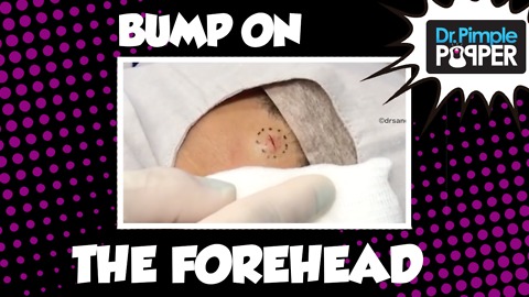 Dr Pimple Popper: A Bluish Bump Squeezed on the Forehead