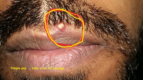 Guy popped the painful Pimple on his Lip.