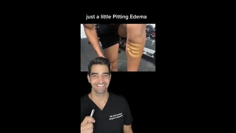 pitting edema