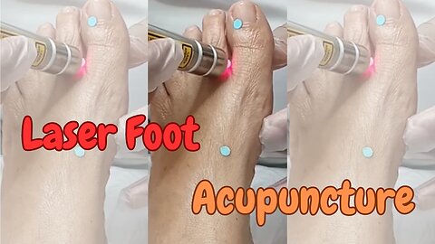 Laser foot acupuncture