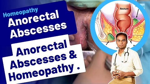 Anorectal Abscesses and Homeopathy Treatment . | Dr. Bharadwaz | Homeopathy, Medicine & Surgery