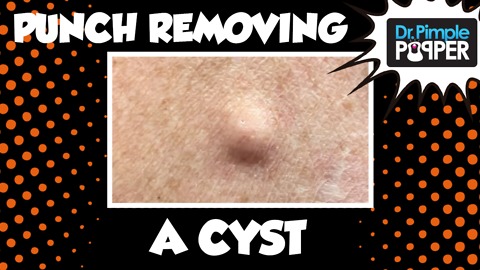 A Punch Removal of a Cyst! With Dr Pimple Popper