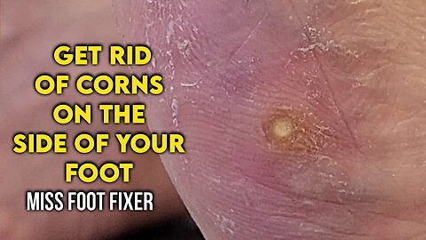 How to Get Rid of Corns on the Side of Your Foot By Foot Specialist Miss Foot Fixer
