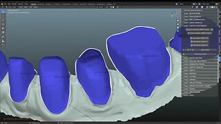 Completing a full lower rehab using Medit Margins